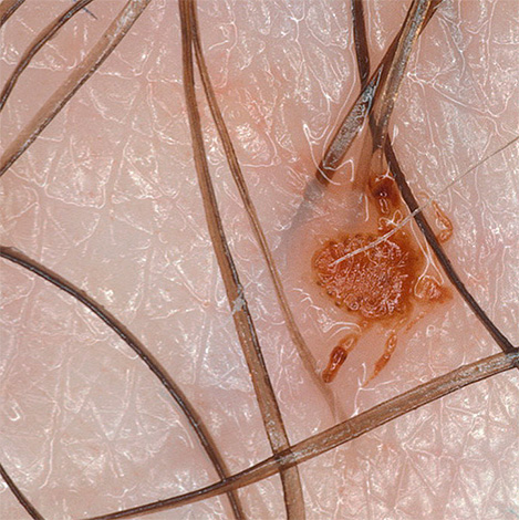 Un autre nom commun pour les poux du pubis est les poux.