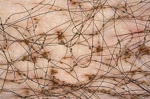 En plus des poux du pubis, vous pouvez également voir de nombreuses lentes sur les cheveux