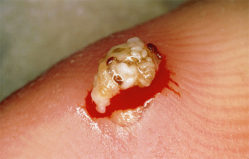 Puce de sable femelle avec oeufs