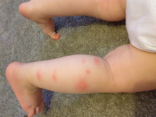 Piqûres de puces sur la jambe d'un enfant