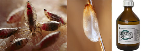 Essayons de déterminer s'il faut éliminer les poux avec du peroxyde d'hydrogène ...