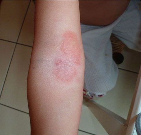 Avant d'utiliser du peroxyde d'hydrogène, assurez-vous de vérifier si la peau n'est pas trop sensible.