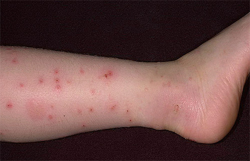 Piqûres de puces sur la jambe