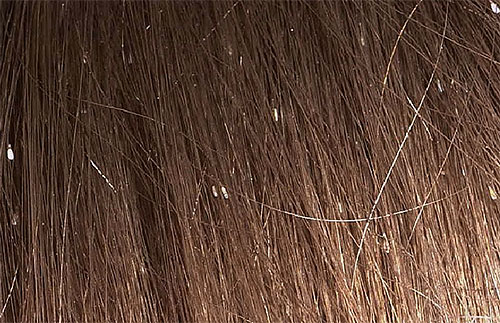 Voici à quoi ressemblent les lentes des cheveux