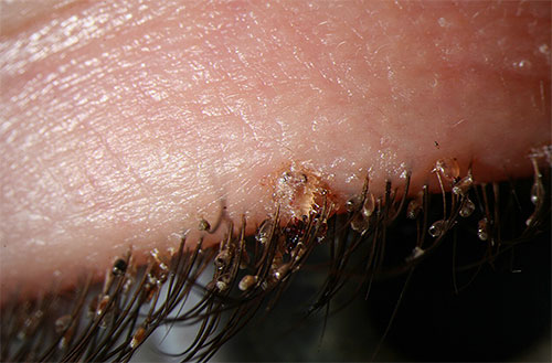 Si un enfant est infecté par des poux du pubis, on peut les voir même sur les cils.