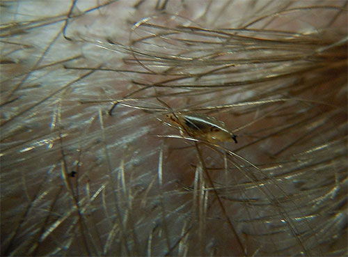 Le pou de tête lui-même dans les cheveux d'un enfant ressemble à un petit insecte léger