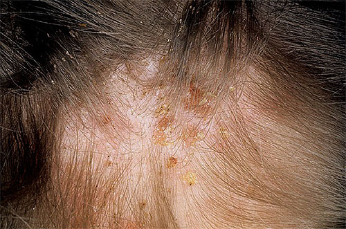 Avec le grattage constant des piqûres de poux, des croûtes se forment sur la peau