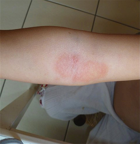 Le test de sensibilité cutanée aux composants de Paranit peut être effectué sur le pli du coude.