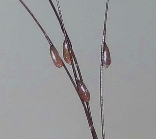 La photo montre des lentes sur les cheveux