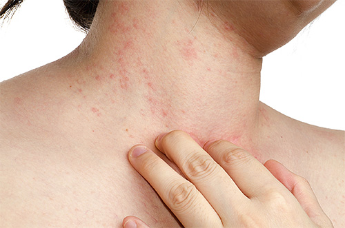 Parfois, l'apparition soudaine d'une allergie peut indiquer la présence de poux.