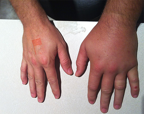 L'endroit où le frelon a piqué gonfle et gonfle sous nos yeux