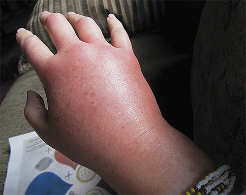 La photo montre un pinceau gonflé après une morsure de frelon.