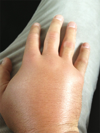 La mandorotoxine, qui fait partie du venin du frelon asiatique, provoque un gonflement rapide des tissus