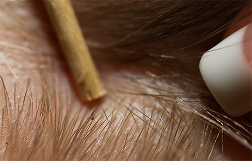 La taille des lentes est si petite qu'elles peuvent facilement passer à travers les dents des peignes ordinaires.