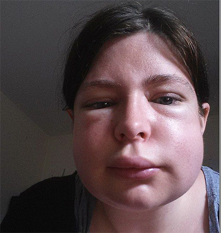 Si une personne est sujette à des manifestations d'allergie aux piqûres d'insectes, après une piqûre de frelon, elle peut développer un œdème de Quincke.