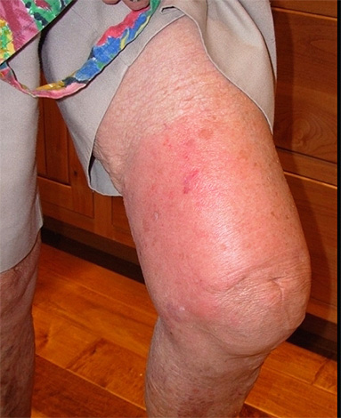 Le venin de frelon agit sur une personne de telle sorte qu'après une morsure, non seulement un gonflement des tissus peut être observé, mais également le travail de divers organes peut être perturbé.