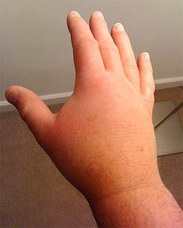 Lorsque vous mordez un frelon, vous n'avez pas besoin de chercher une piqûre sous la peau, mais vous devez traiter immédiatement la plaie.