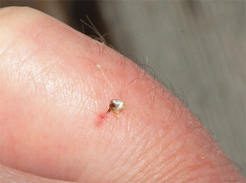 Piqûre d'abeille laissée dans la peau humaine