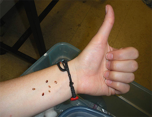 Lorsqu'il y a beaucoup de punaises de lit dans la maison, leurs piqûres sont loin d'être aussi anodines qu'il y paraît avec un petit nombre de parasites dans la chambre.