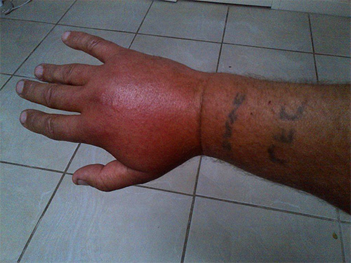 Les piqûres de frelon peuvent provoquer un gonflement très important des tissus.