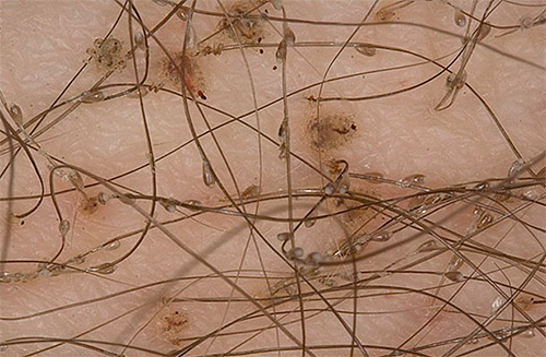 Les poux du pubis ne peuvent vivre que dans les cheveux humains, ce qui simplifie la procédure de traitement.