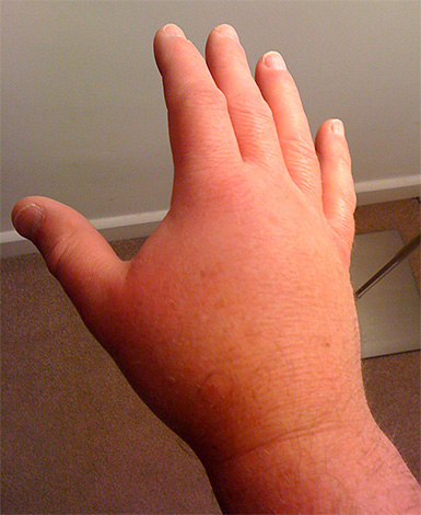 Si la taille de l'endroit mordu par un insecte a considérablement augmenté et que l'essoufflement est apparu, il vaut la peine de prendre un antihistaminique et d'aller à l'hôpital.