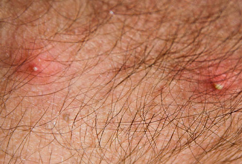 Voici à quoi ressemblent les piqûres de poux enflammées