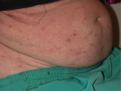 La photo montre de nombreuses piqûres de poux de corps (lin)