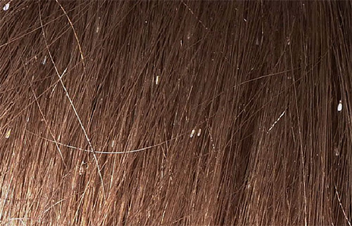 Les lentes ressemblent à de petits points blancs