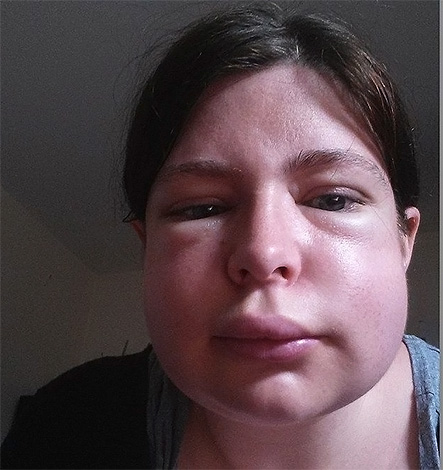 Conséquences d'une morsure de frelon au visage