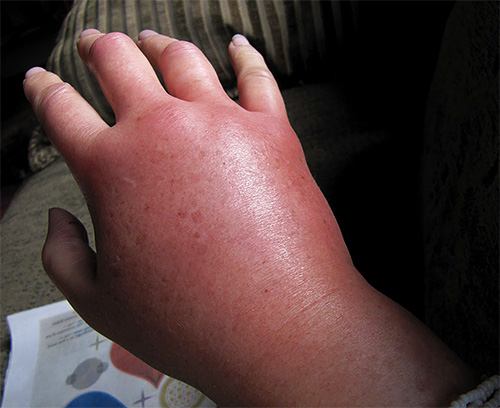 Voici à quoi ressemble la main après avoir été mordue par un frelon.