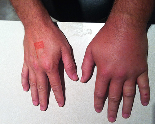 Dans un court laps de temps après une morsure de frelon, la zone endommagée gonfle fortement.