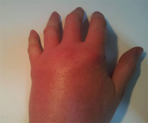 Quelques minutes après la morsure, l'endroit touché par le poison gonfle fortement.