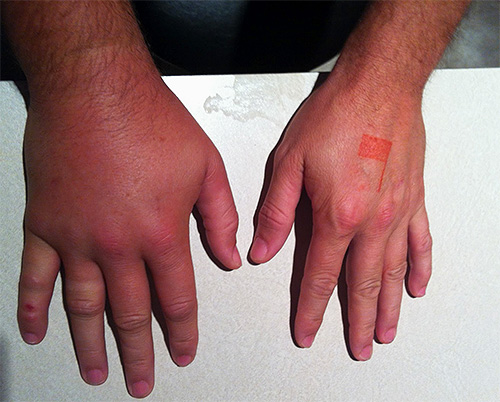 Après une piqûre de frelon, les tissus affectés par le poison peuvent gonfler gravement, parfois une puissante réaction allergique se développe.