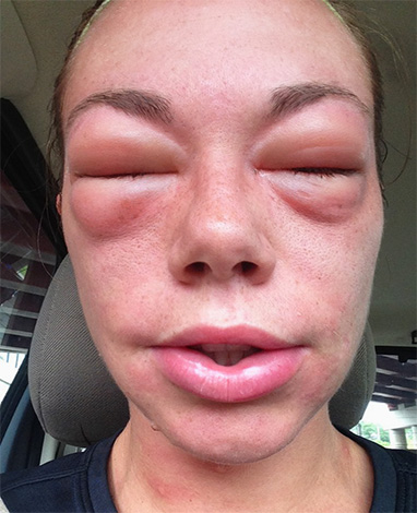 Si, après une morsure de frelon, une réaction allergique générale du corps se développe rapidement, il est impossible de retarder les premiers secours ...