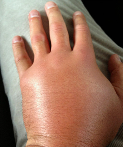 Les médicaments pris en temps opportun aident à prévenir le développement de maladies potentiellement mortelles.