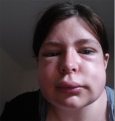 Si la réaction du corps à la piqûre de frelon continue de s'intensifier, la victime doit être transportée à l'hôpital dès que possible.