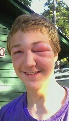 Même si immédiatement après la morsure, l'état de santé reste normal, il peut rapidement s'aggraver à l'avenir.