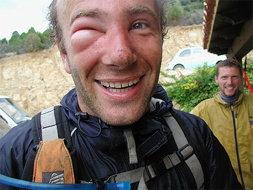 Certaines personnes deviennent plus sensibles au venin d'insecte à chaque nouvelle piqûre, ce qui peut être dangereux.