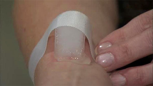 Si vous appliquez de la glace à l'endroit mordu par la guêpe, cela aidera à réduire la gravité de l'œdème.