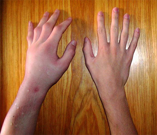 Même si le site de la morsure est enflé et démange, il disparaît souvent assez rapidement sans aucune conséquence.