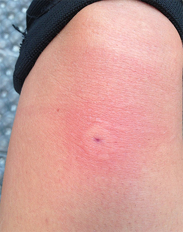 Si vous avez été piqué par une guêpe dans la nature, vous pouvez utiliser l'un des remèdes populaires.