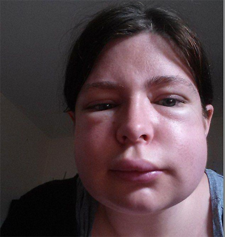 L'une des conséquences les plus dangereuses d'une piqûre de guêpe est le gonflement rapide du larynx, qui conduit souvent à la suffocation.