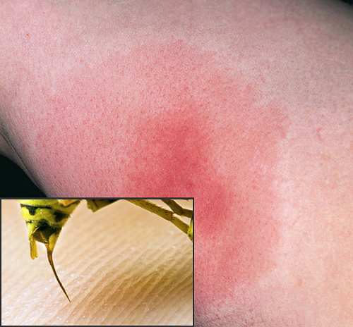 Si, après une piqûre de guêpe, la zone touchée devient très irritante, il est temps de prendre certaines mesures. Mais quoi exactement - nous en reparlerons plus loin.