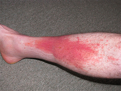 Le venin de guêpe peut provoquer des hémorragies dues à la destruction de petits vaisseaux sanguins