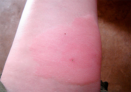 Les conséquences de l'action du venin d'insecte ne se limitent pas à la zone affectée visible, certains changements peuvent être observés dans le travail de tout l'organisme.