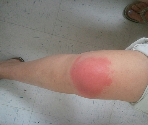 Une piqûre de guêpe provoque souvent des démangeaisons