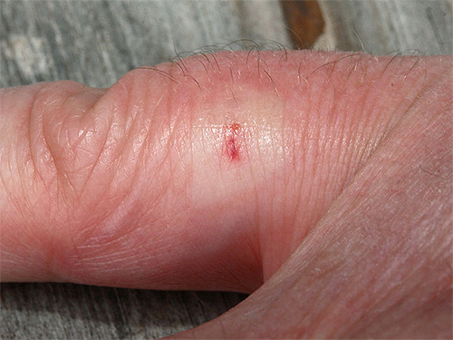 Voici à quoi ressemble une piqûre de guêpe quelques minutes après avoir piqué