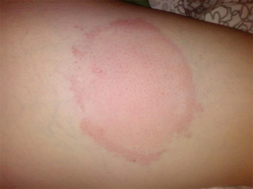 Et voici à quoi ressemble la zone touchée après environ une journée