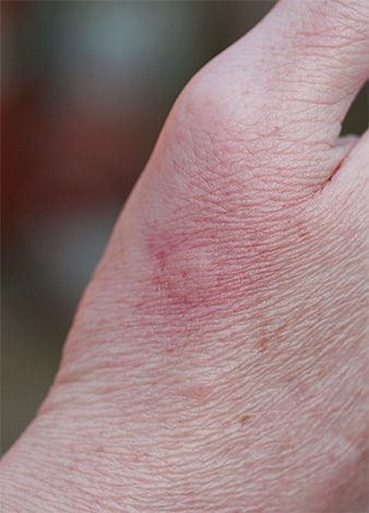 Une réaction normale à une piqûre de guêpe est une légère rougeur localisée et un léger gonflement.